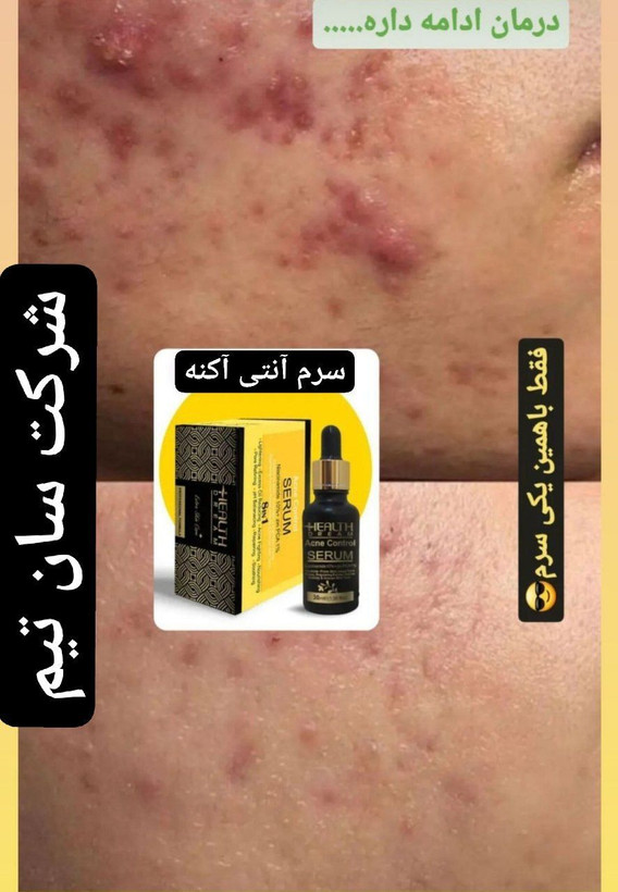 سرم آنتی آکنه Niacinamide۱۰% + Zinc PCA۱%-بیوتی دریم