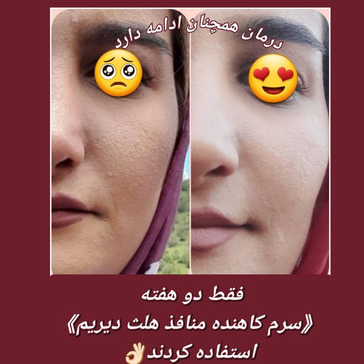سرم تخصصی Pore Minimizer بهبود منافذ پوست AHA۱۰% +SA ۲%-بیوتی دریم